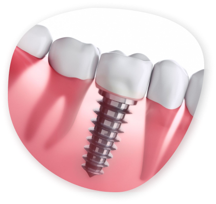 https://www.smileformilesdental.com/wp-content/uploads/2024/01/Dental-implant1.png